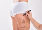 Liposuction That Transforms Proven Tips from Best Liposuction Surgeon in Dubai