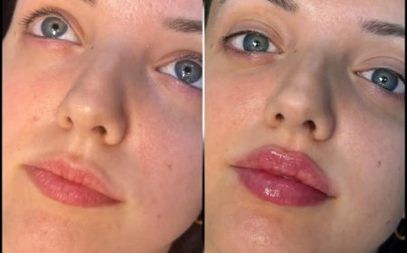 Best Aesthetic Clinic in dubai for Fillers: How to Choose Between Treatment Options