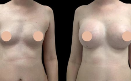 Comparing Options for Breast Augmentation in Dubai