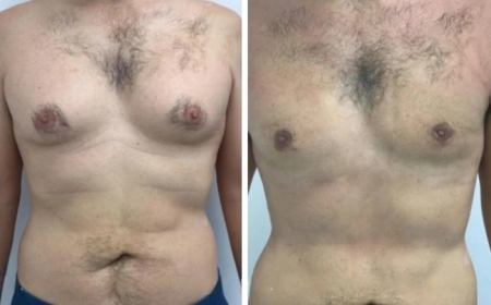 How to Manage Recovery Time After Gynecomastia in Dubai Surgery