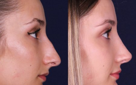 Refining Your Profile: A Complete Guide to Chin Lipo in NYC