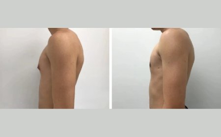 How to Mentally Prepare for Gynecomastia Surgery in Dubai