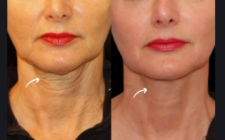 Tired of Sagging Skin? Try Sculptra Fillers Treatment in Dubai