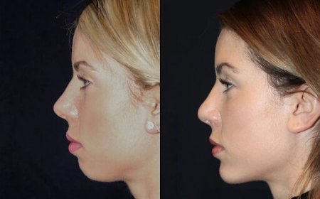 Best Doctors in dubai for Chin Fillers: How to Achieve the Perfect Chin
