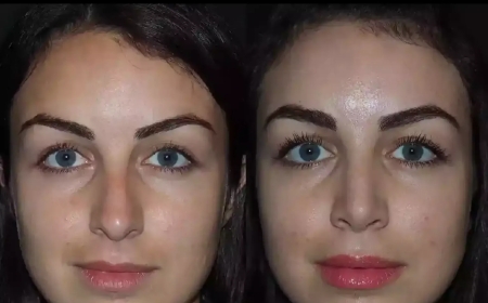 Rhinoplasty in Dubai: What to Expect During the Consultation