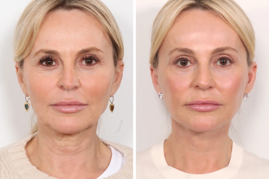 Best Aesthetic Clinic in Dubai: Thread Lift vs. Traditional Facelift – Which is Right for You
