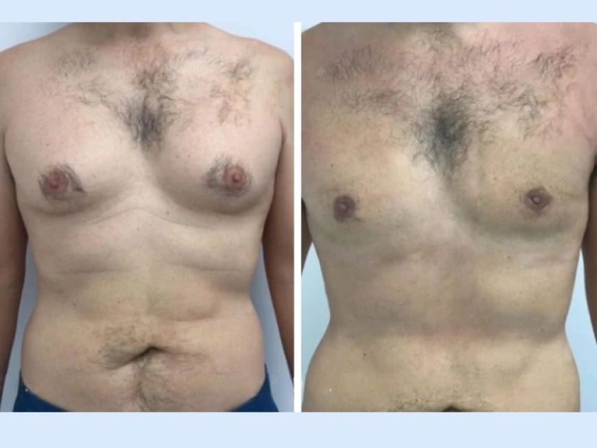 How to Manage Recovery Time After Gynecomastia in Dubai Surgery