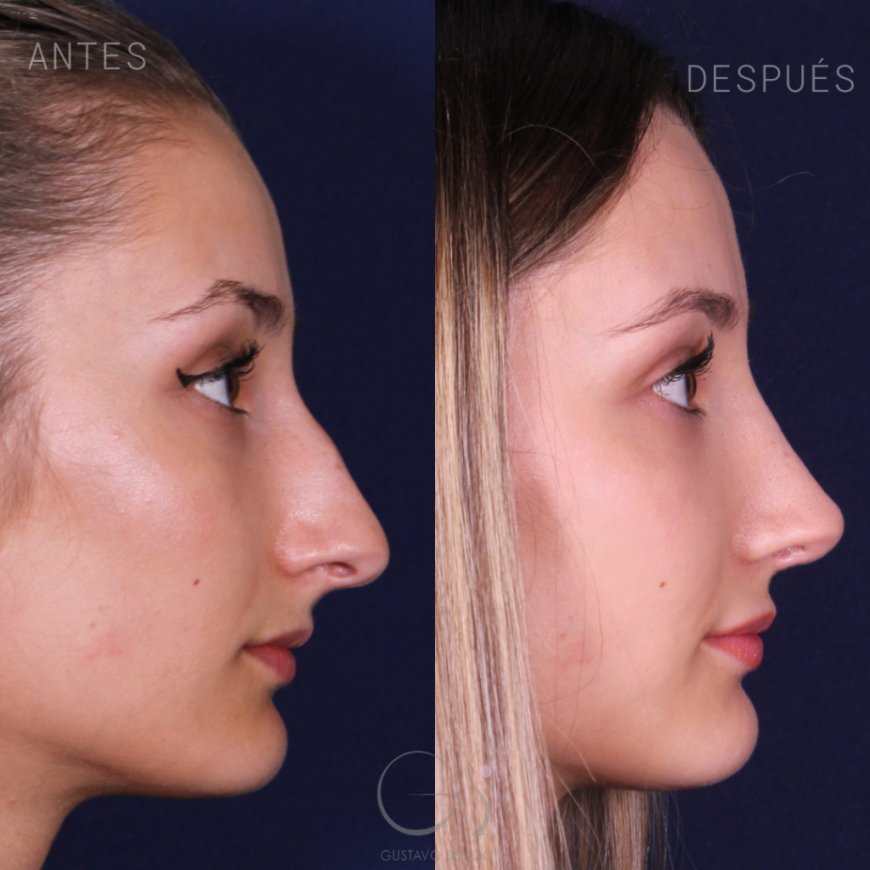 Refining Your Profile: A Complete Guide to Chin Lipo in NYC