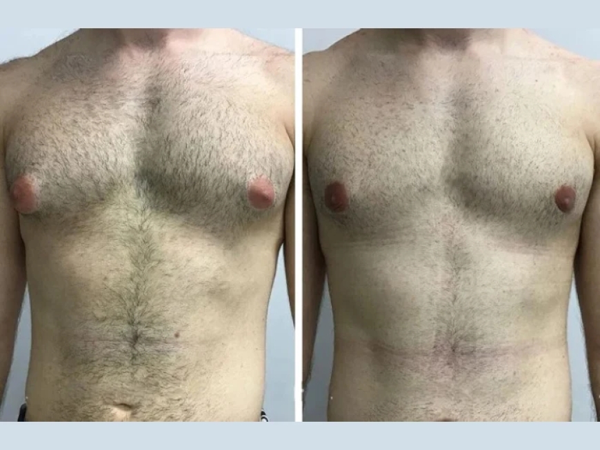 Non-Surgical Options vs. Surgery: What the Best Gynecomastia Surgeon in Dubai Recommends