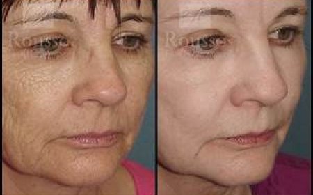 Chemical Peel Before and After for Anti-Aging: See the Difference