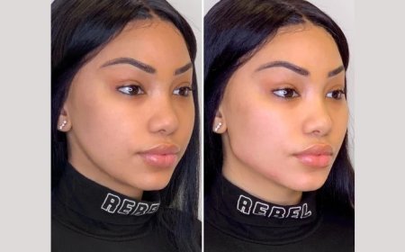 What Makes Thread Lift One of the Most Popular Treatments at the Best Aesthetic Clinic in Dubai