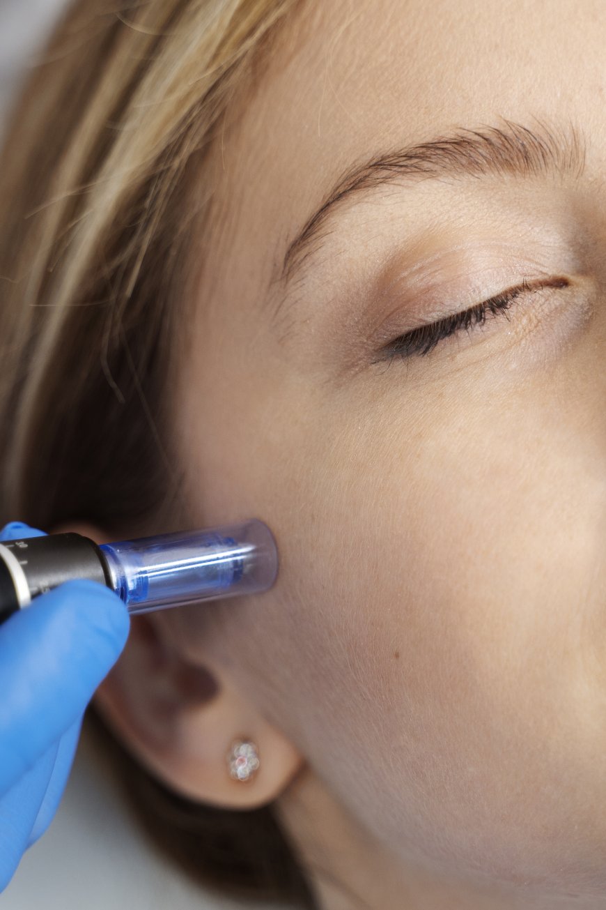 Micro Needling with Acupuncture Benefits: The Ultimate Solution for Natural Skin and Health Rejuvenation