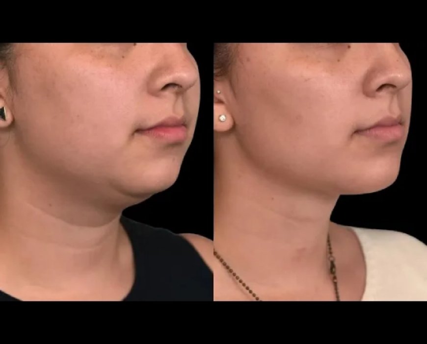 Best Doctors in Dubai Share Step-by-Step Double Chin Removal Plan