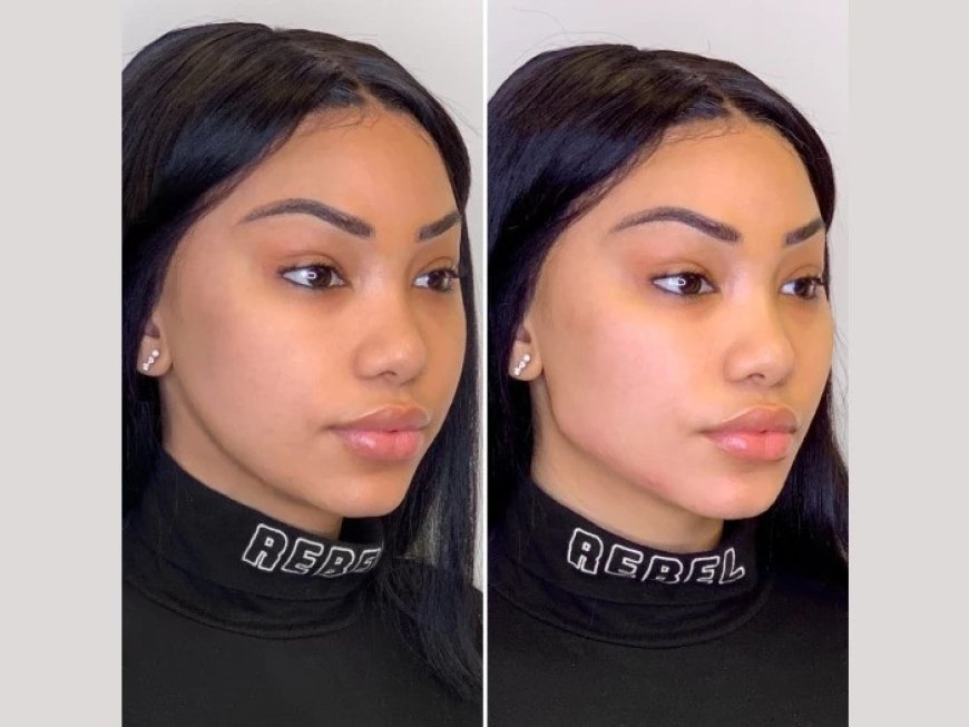 What Makes Thread Lift One of the Most Popular Treatments at the Best Aesthetic Clinic in Dubai